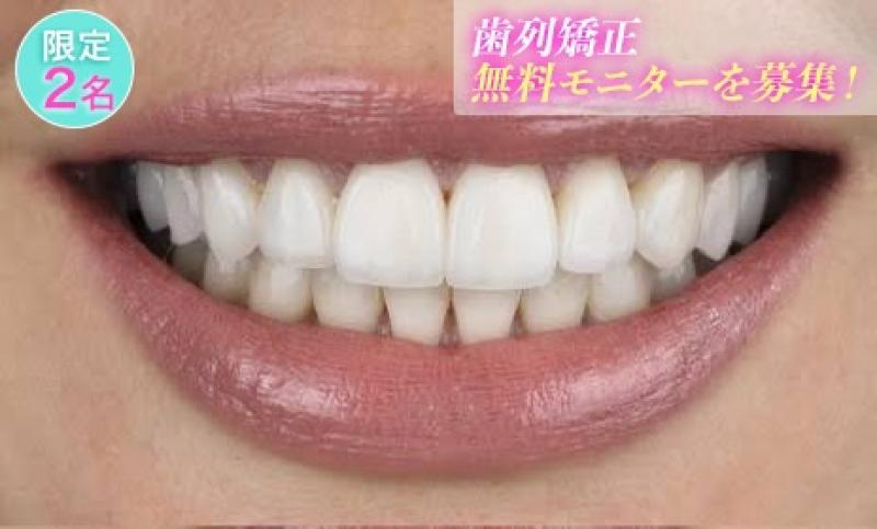 歯列矯正 無料モニター 募集