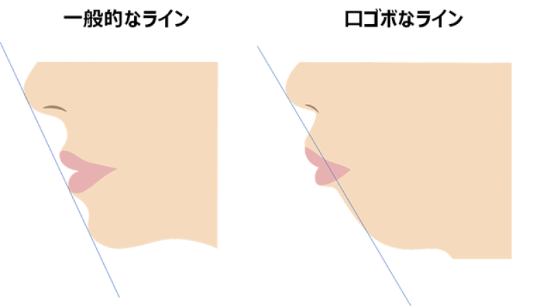口ゴボの方、歯並びが悪い方！撮影にご協力お願い致します！ サブ画像